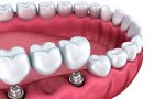 Porcelain Crowns and Bridges -...