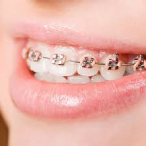 Braces - Aiko Dental and Implant Center