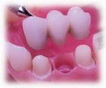 Crown and Bridge Work  - Aiko Dental and Implant Center