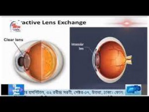 Cataract and Phaco Surgery - Dhaka Eye Care Hospital