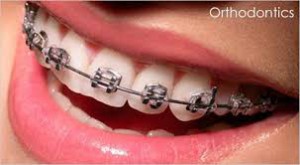 Orthodontic -  Johnsons Place Dental Lab