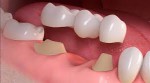 Dental Bridge -  Johnsons...